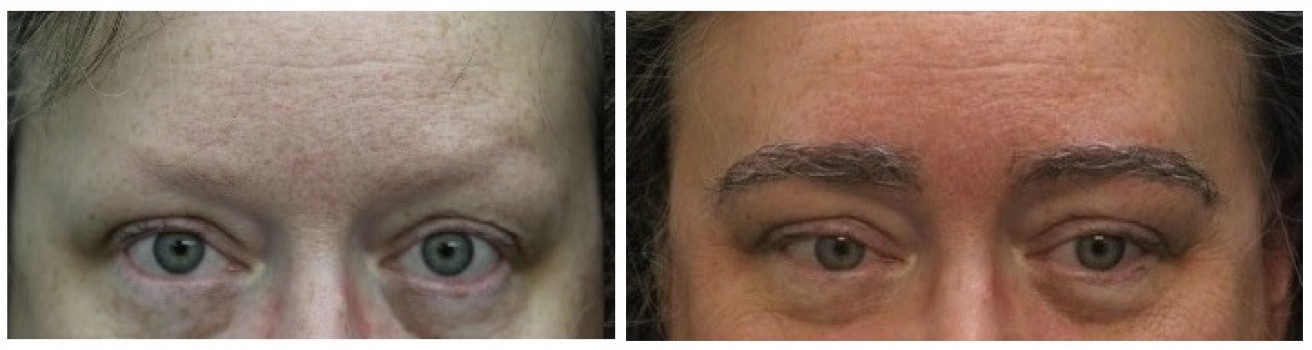 Eyebrow transplant in germany. Brows transplant pictures.